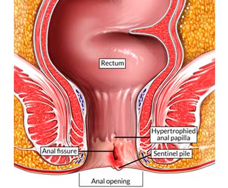 Graphic representation of an anal fisure, where the opening of the anus is being presented and a split is being shown in red on the walls, close to the opening.